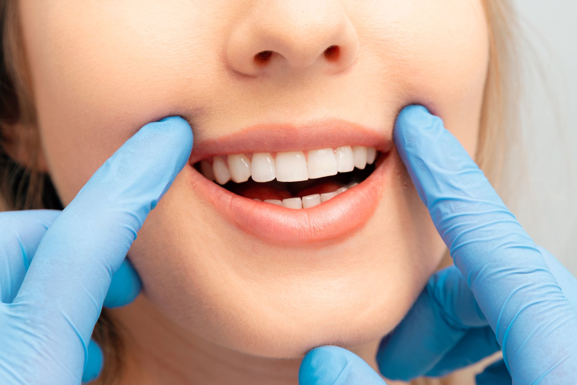 A close-up of a patient’s healthy smile being gently examined by a Luf Dental professional wearing blue gloves.