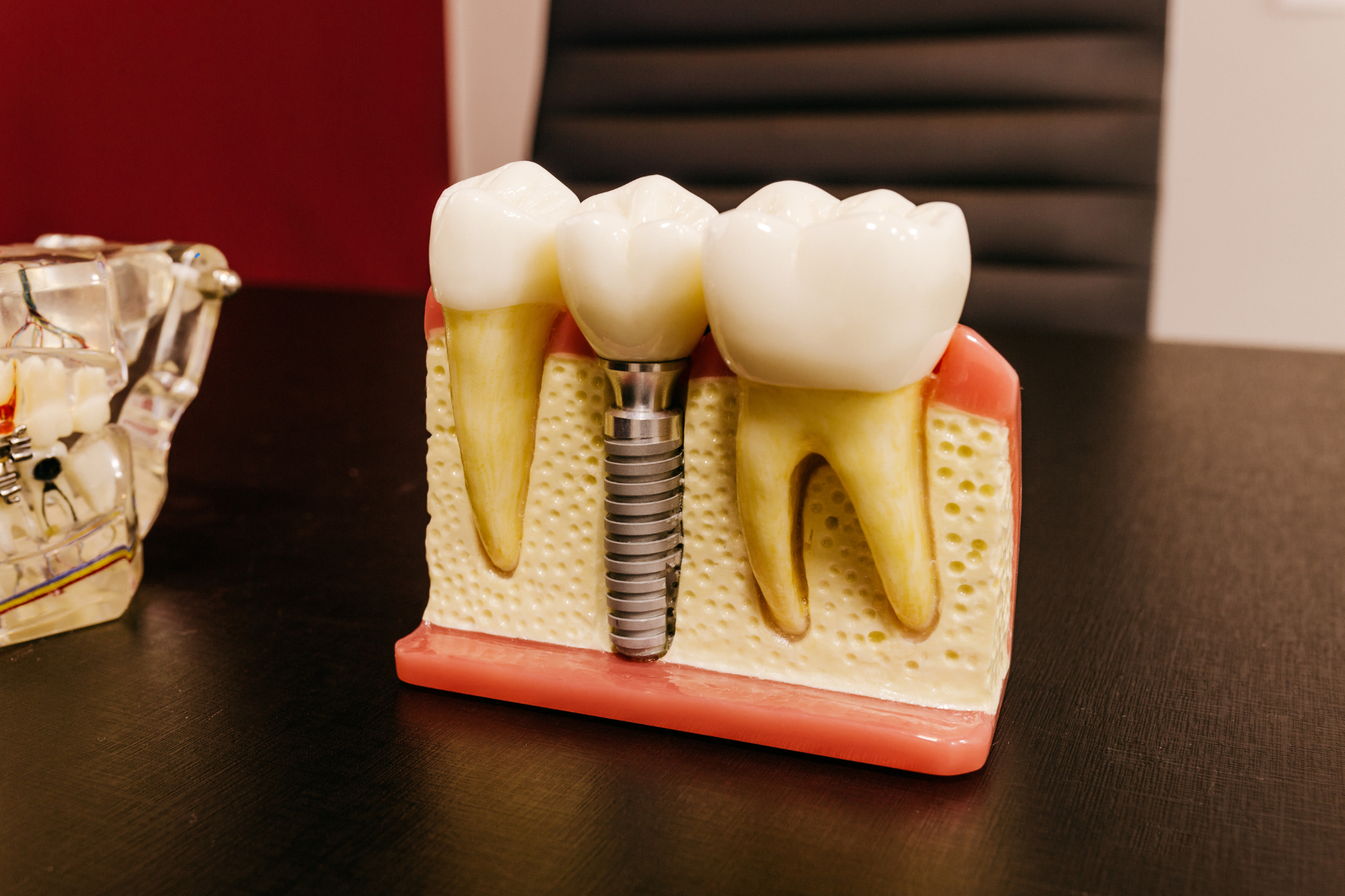 A close-up of a dental implant model showcasing a titanium implant post integrated into the jawbone, with natural-looking crowns and adjacent teeth